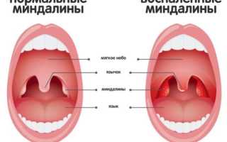 Как промываются лакуны миндалин?